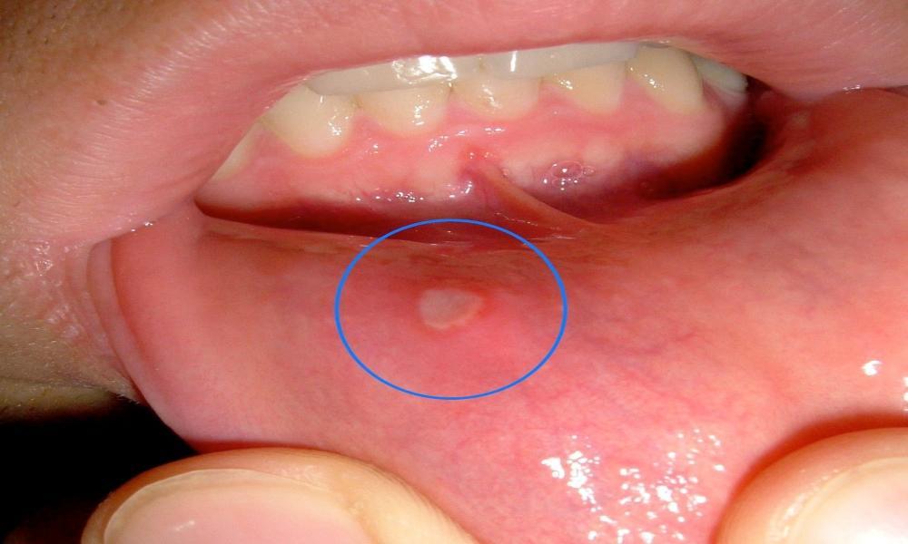 Can Too Much Sugar Cause Canker Sores?
