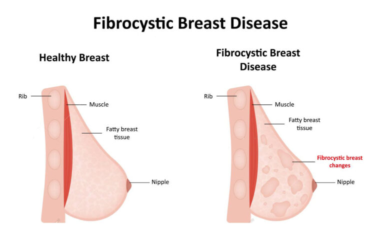 Can Caffeine Cause Lumps In Breast?